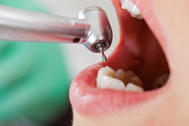 Best Emergency Root Canal Treatment in Diboll, TX